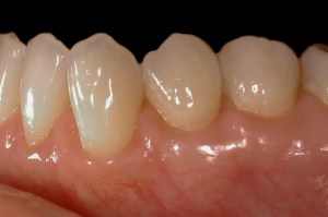 before and after dental procedure in greater houston