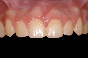before and after dental procedure in greater houston