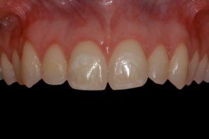 smile gallery front teeth