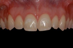 smile gallery front teeth