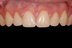 before and after dental procedure in greater houston