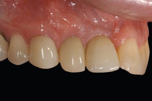 before and after dental procedure in greater houston