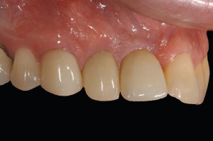 before and after dental procedure in greater houston