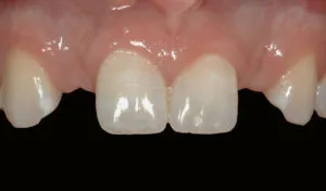 smile gallery front teeth