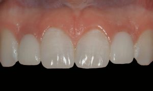 smile gallery front teeth