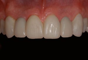 Smile Galley front teeth after implants