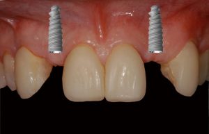 smile gallery front teeth w/ dental screw images
