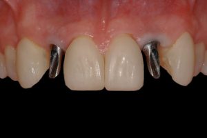 smile gallery front teeth w/ dental screw in place