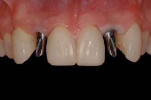 smile gallery front teeth w/ dental screw in place