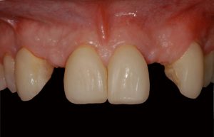 smile gallery front teeth