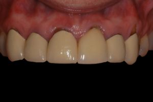 smile gallery front teeth