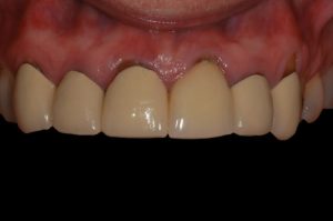 smile gallery front teeth