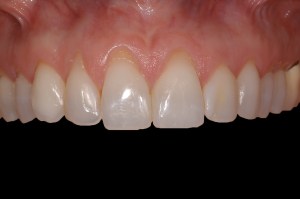 before and after dental procedure in greater houston