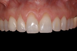 before and after dental procedure in greater houston