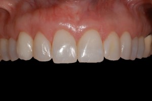 before and after dental procedure in greater houston