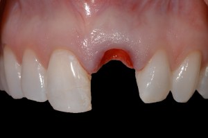 before and after dental procedure in greater houston