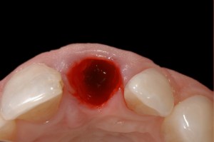 before and after dental procedure in greater houston