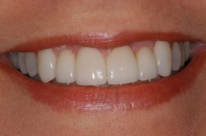 smile gallery front teeth after implants