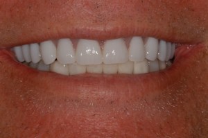 before and after dental procedure in greater houston