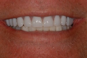 before and after dental procedure in greater houston