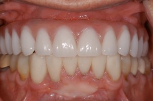 before and after dental procedure in greater houston
