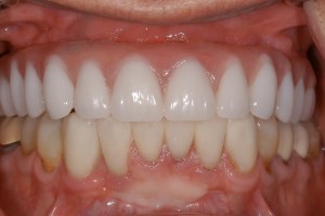 before and after dental procedure in greater houston