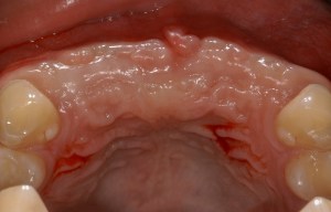 before and after dental procedure in greater houston