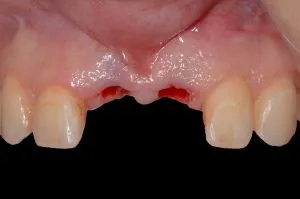 before and after dental procedure in greater houston