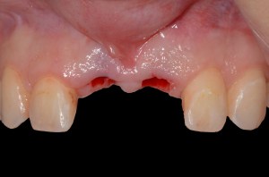 before and after dental procedure in greater houston