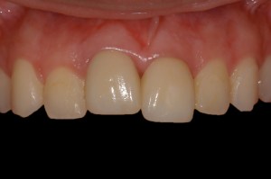 before and after dental procedure in greater houston