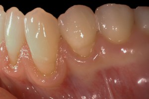 before and after dental procedure in greater houston