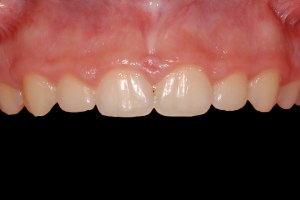 before and after dental procedure in greater houston
