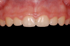 before and after dental procedure in greater houston