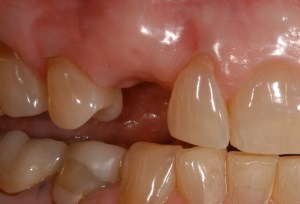 before and after dental procedure in greater houston