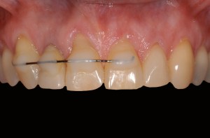 before and after dental procedure in greater houston