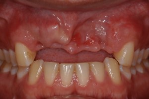 before and after dental procedure in greater houston