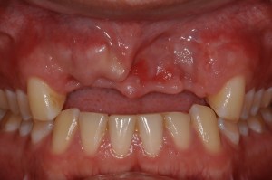 before and after dental procedure in greater houston