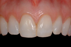 before and after dental procedure in greater houston