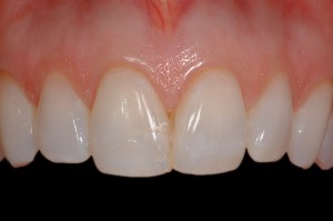 before and after dental procedure in greater houston