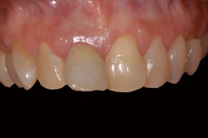 before and after dental procedure in greater houston