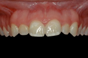 smile gallery front teeth