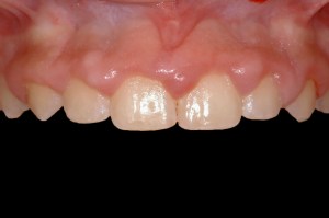 before and after dental procedure in greater houston
