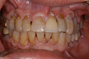 before and after dental procedure in greater houston