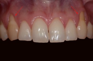before and after dental procedure in greater houston