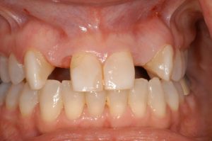 Smile Gallery before implants