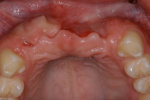 before and after dental procedure in greater houston