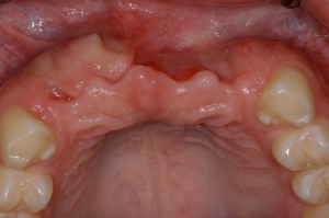 before and after dental procedure in greater houston