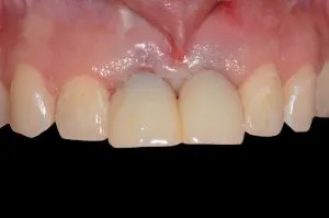 before and after dental procedure in greater houston
