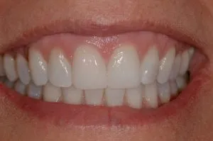 before and after dental procedure in greater houston