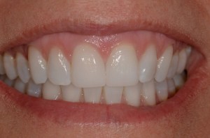 before and after dental procedure in greater houston